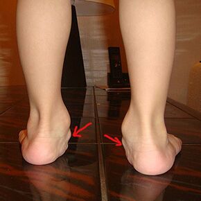 Valgus