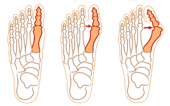 Hallux valgus deformasy