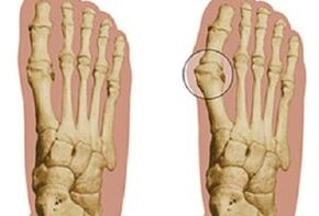 Causes of Hallux Valgus