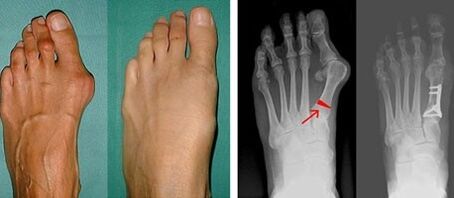 Hallux valgus symptoms