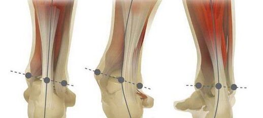 In the case of Plano-Valgus deformity, the norm of the foot axis and its curvature