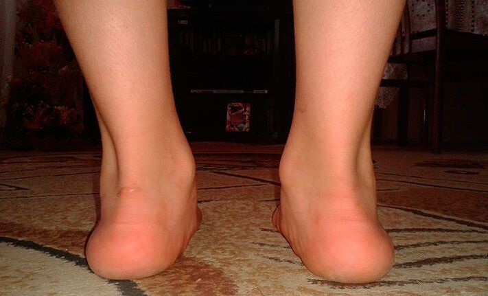 Straight valgus feet