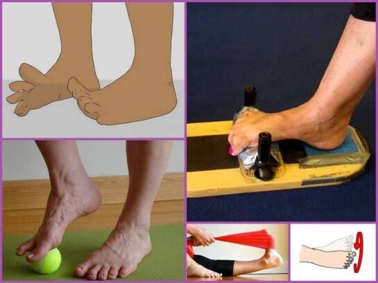 Therapy Therapy for Plano-Valgus Foot Deformity
