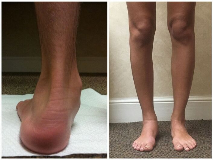 Feet with hallux valgus