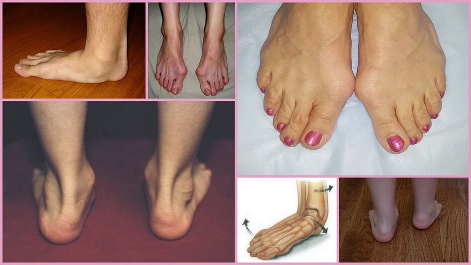 Manifestations of foot valgus in adults