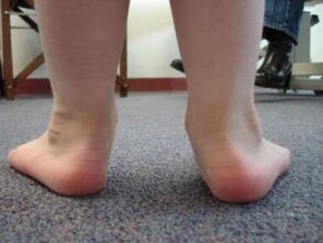 Flat valgus deformity of the foot in a child
