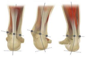 Normal foot with valgus and varus deviation of the calcaneus