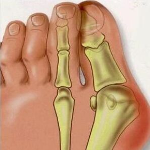 Causes of Valgus