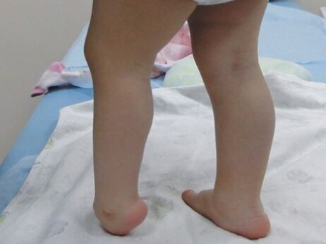 The first symptoms of the deformation of the skirt