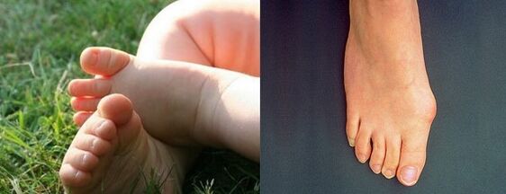Valgus deformation of the first finger of the skirt