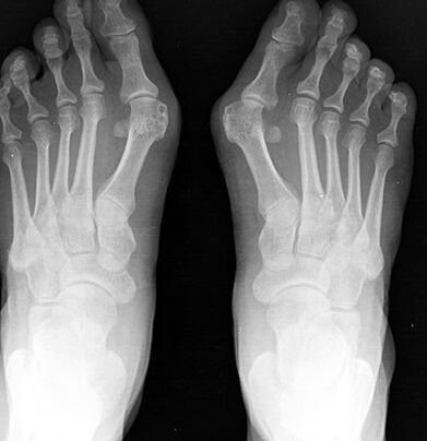 X-foot